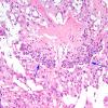 7D7 Ependymoma, myxopapillary, anaplastic fx (Case 7) - endothel hyp H&E 2A.jpg