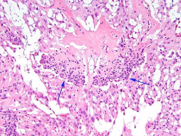 7D7 Ependymoma, myxopapillary, anaplastic fx (Case 7) - endothel hyp H&E 2A.jpg