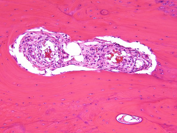 7D8 Ependymoma, myxopapillary, anaplastic fx (Case 7) - H&E bone invasion 2.jpg