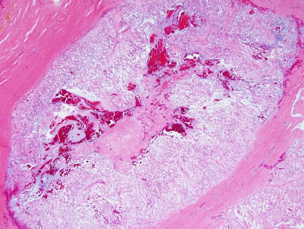 7D9 Ependymoma, myxopapillary, anaplastic fx (Case 7) - H&E comedo necrosis 1A.jpg