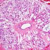 7E0 Ependymoma, myxopapillary, anaplastic fx (Case 7) - H&E pseudorosetteA.jpg