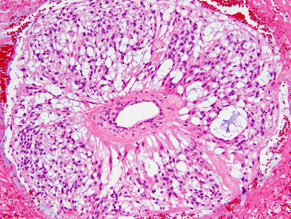 7E0 Ependymoma, myxopapillary, anaplastic fx (Case 7) - H&E pseudorosetteA.jpg