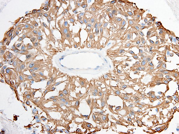 7E1 Ependymoma, myxopapillary, anaplastic fx (Case 7) - GFAP 1.jpg