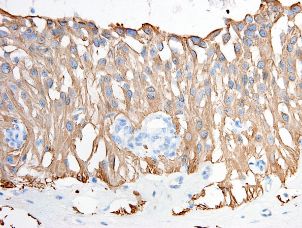 7E2 Ependymoma, myxopapillary, anaplastic fx (Case 7) - endothel hyp GFAP 1A.jpg