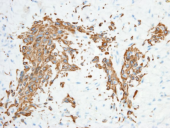 7E3 Ependymoma, myxopapillary, anaplastic fx (Case 7) - single cell invasion GFAP 2.jpg