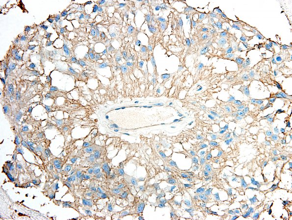 7F Ependymoma, myxopapillary, anaplastic fx (Case 7) - CD99-O13-2A.jpg