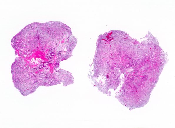 8A1 Ependymoma, myxopapillary (Case 8) 1 H&E WM