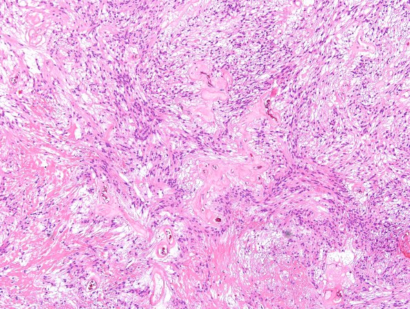 8A2 Ependymoma, myxopapillary (Case 8) H&E 1