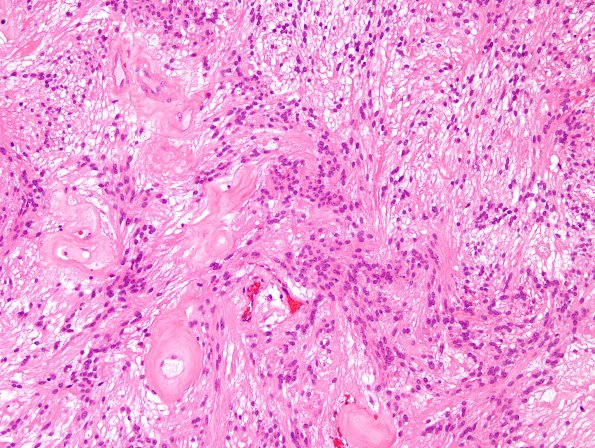 8A3 Ependymoma, myxopapillary (Case 8) H&E 2