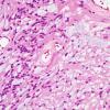 8A4 Ependymoma, myxopapillary (Case 8) H&E 7