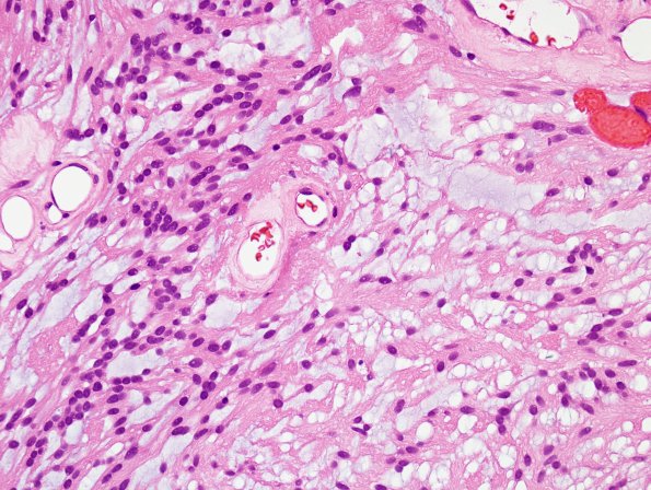 8A4 Ependymoma, myxopapillary (Case 8) H&E 7