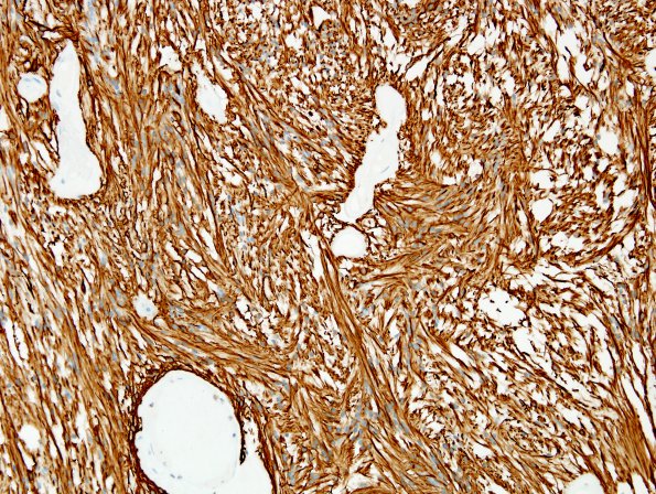 8B1 Ependymoma, myxopapillary (Case 8) GFAP 1