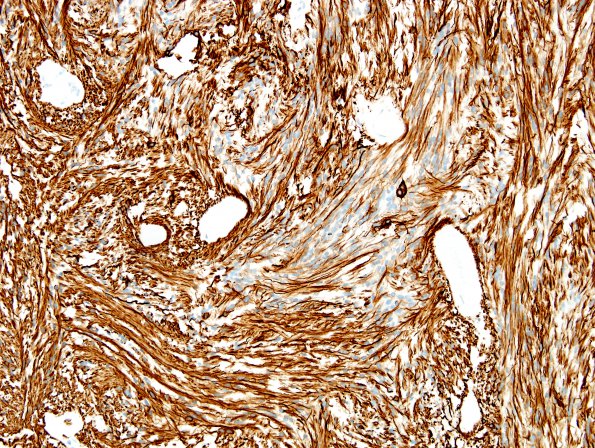 8B2 Ependymoma, myxopapillary (Case 8) GFAP 5