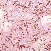 8C1 Ependymoma, myxopapillary (Case 8) Mucicarmine 9