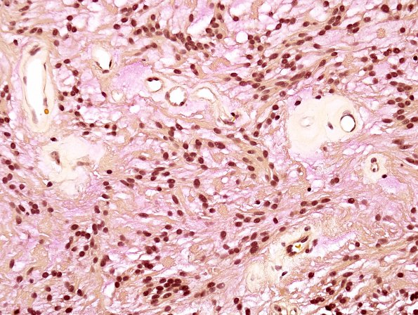 8C1 Ependymoma, myxopapillary (Case 8) Mucicarmine 9