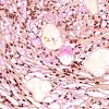 8C2 Ependymoma, myxopapillary (Case 8) Mucicarmine 1