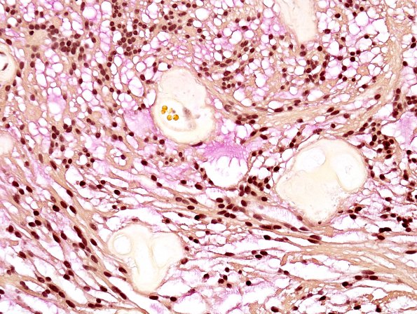 8C2 Ependymoma, myxopapillary (Case 8) Mucicarmine 1