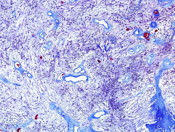 8D1 Ependymoma, myxopapillary (Case 8) Trichrome 2