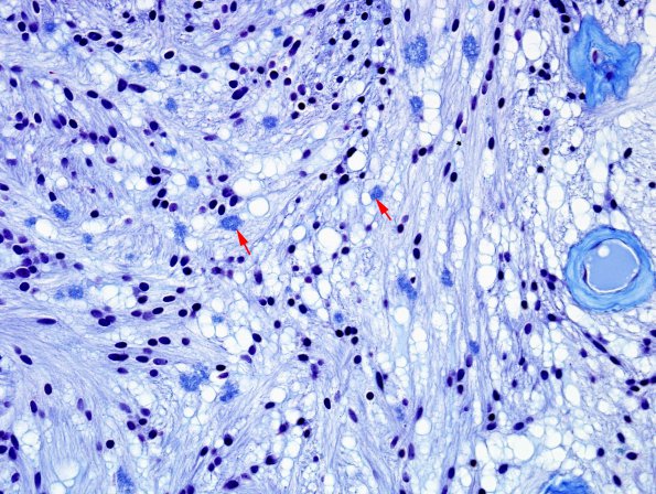 8D2 Ependymoma, myxopapillary (Case 8) Trichrome 5 copy