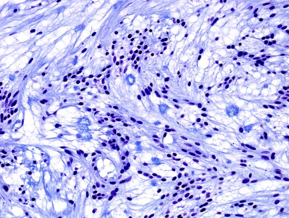 8D3 Ependymoma, myxopapillary (Case 8) Trichrome 3