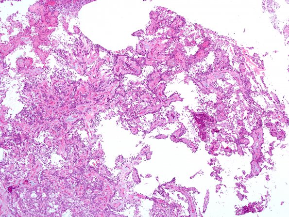 9A1 Ependymoma, myxopapillary (Case 9) H&E 3