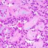 9A2 Ependymoma, myxopapillary (Case 9) 3.jpg