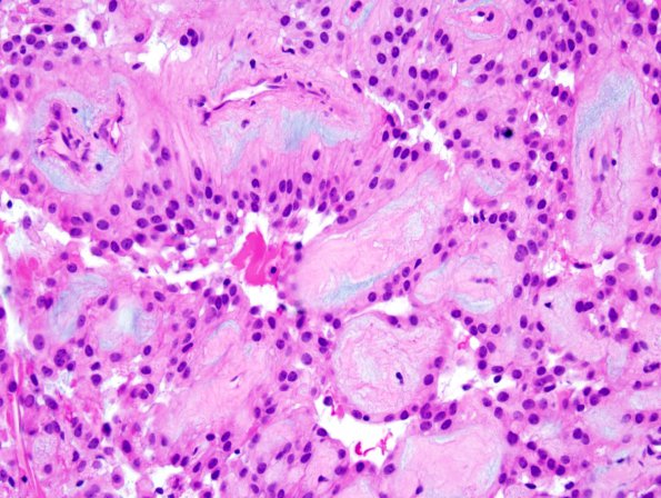 9A2 Ependymoma, myxopapillary (Case 9) 3.jpg