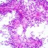 9A3 Ependymoma, myxopapillary (Case 9) Smear 2.jpg