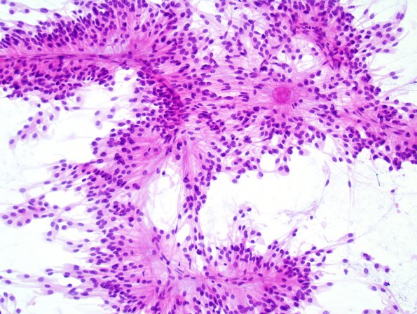 9A3 Ependymoma, myxopapillary (Case 9) Smear 2.jpg