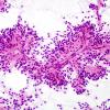 9A4 Ependymoma, myxopapillary (Case 9) Smear 8