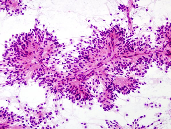 9A4 Ependymoma, myxopapillary (Case 9) Smear 8