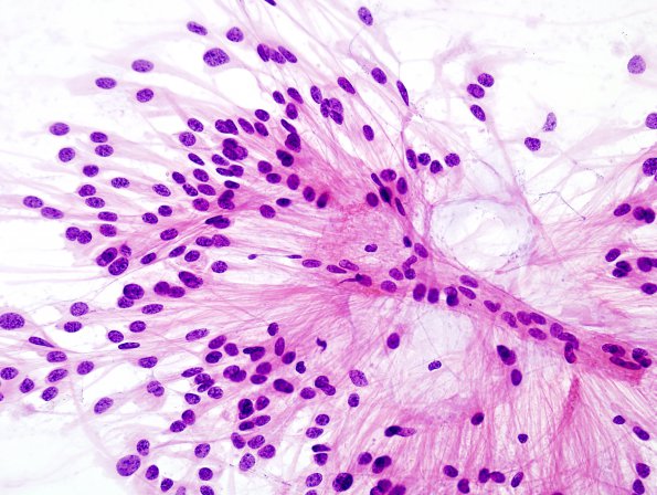 9A5 Ependymoma, myxopapillary (Case 9) Smear 6