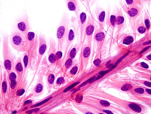 9A6 Ependymoma, myxopapillary (Case 9) H&E 100X