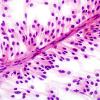 9A7 Ependymoma, myxopapillary (Case 9) Smear 9