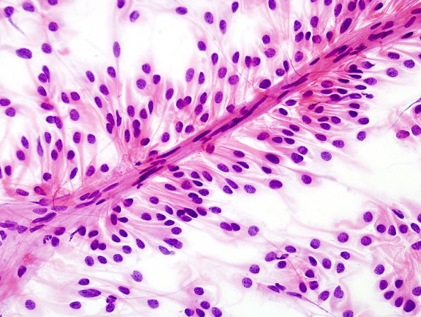 9A7 Ependymoma, myxopapillary (Case 9) Smear 9