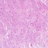 1A1 Ependymoma, tanycytic (Case 1) H&E 4 (2)