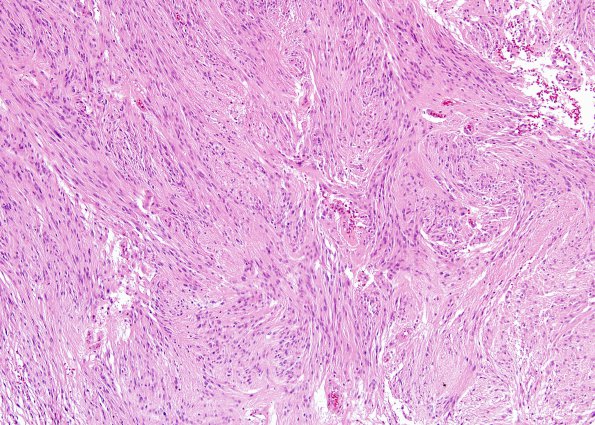 1A1 Ependymoma, tanycytic (Case 1) H&E 4 (2)