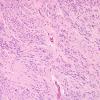 1A2 Ependymoma, tanycytic (Case 1) H&E 1 (2)