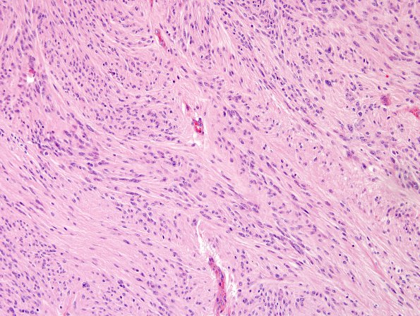 1A2 Ependymoma, tanycytic (Case 1) H&E 1 (2)