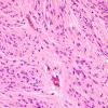 1A3 Ependymoma, tanycytic (Case 1) H&E 2 (2).