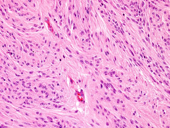 1A3 Ependymoma, tanycytic (Case 1) H&E 2 (2).