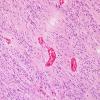 1A4 Ependymoma, tanycytic (Case 1) H&E 6 (2).