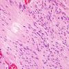 1A5 Ependymoma, tanycytic (Case 1) H&E 7 (2)