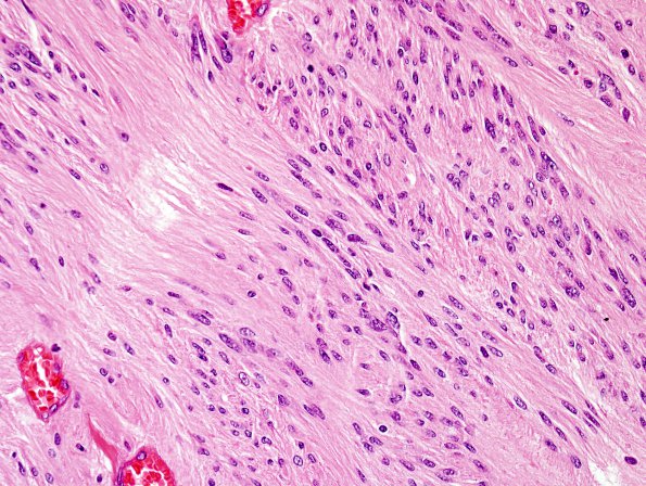 1A5 Ependymoma, tanycytic (Case 1) H&E 7 (2)