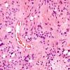 1A6 Ependymoma, tanycytic (Case 1) H&E 7