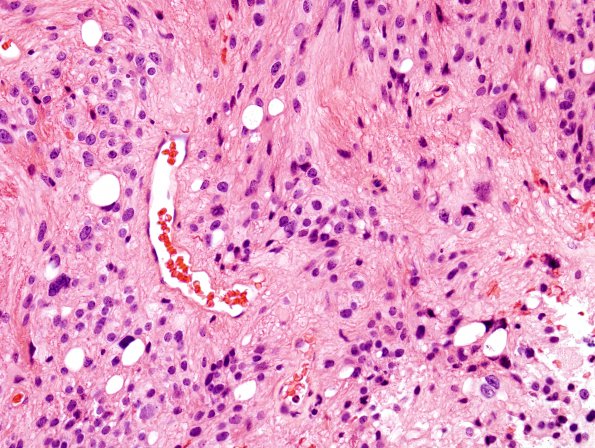 1A6 Ependymoma, tanycytic (Case 1) H&E 7