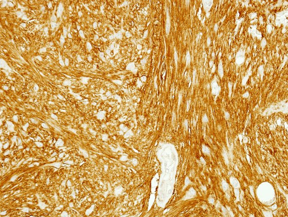 1D1 Ependymoma, tanycytic (Case 1) CD99 1