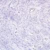 1E Ependymoma, tanycytic (Case 1) NF 2.j