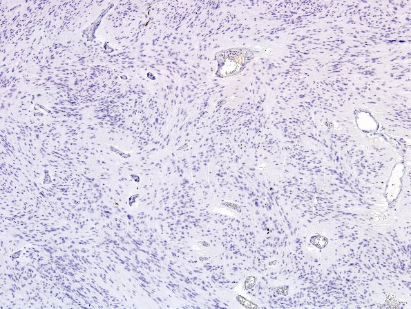 1E Ependymoma, tanycytic (Case 1) NF 2.j