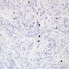 1F Ependymoma, tanycytic (Case 1) Ki67 2